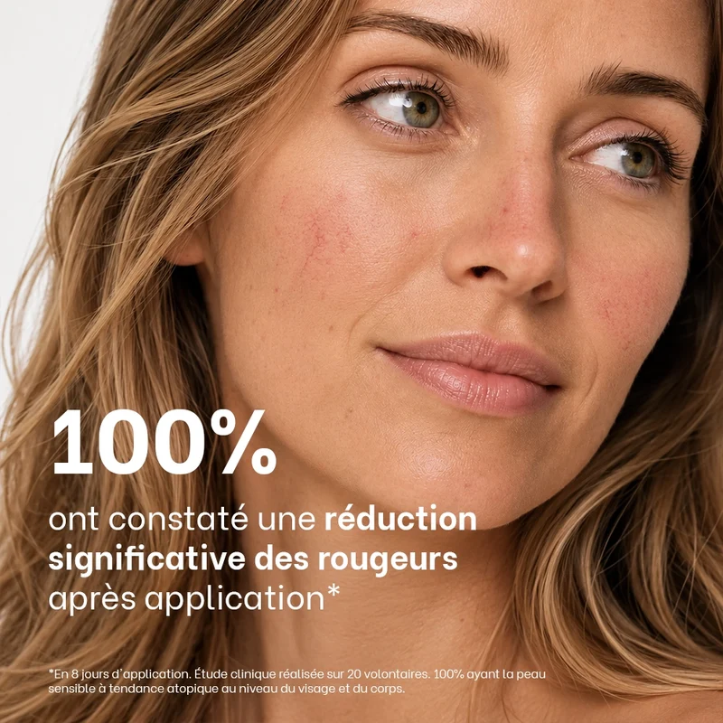 Routine rosacée, couperose