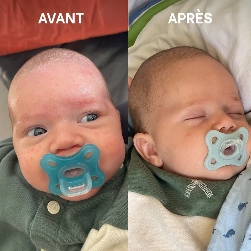Routine SOS eczéma - Bébé