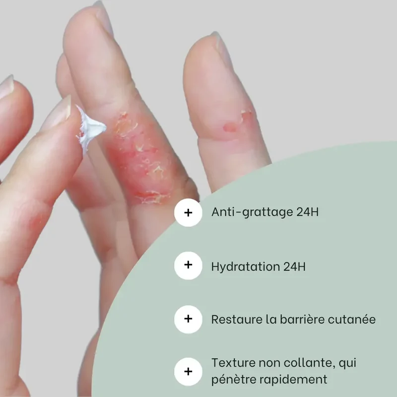 Trio eczéma des mains