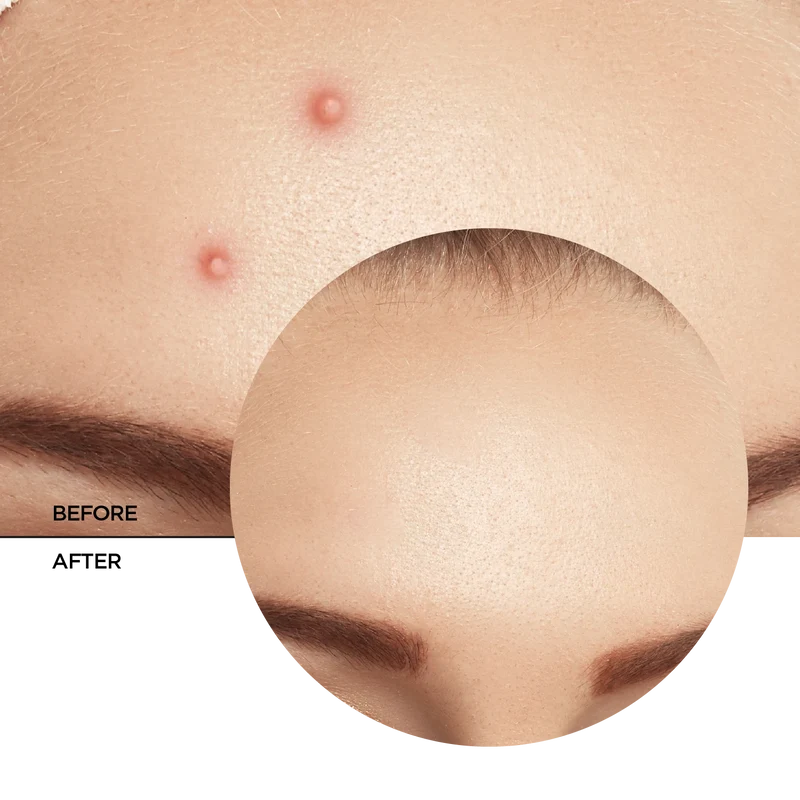 AHA BHA PHA Spot Treatment