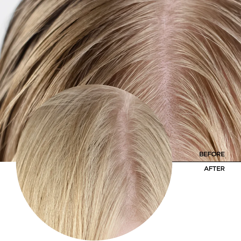 Salicylic Acid 2% for Scalp