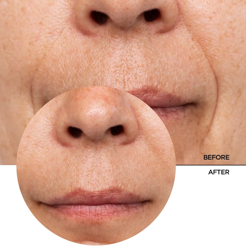Retinol in Squalane