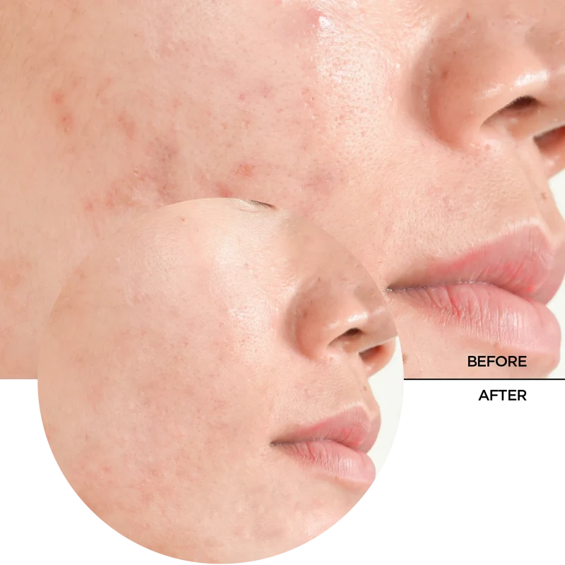 Salicylic Acid 2%
