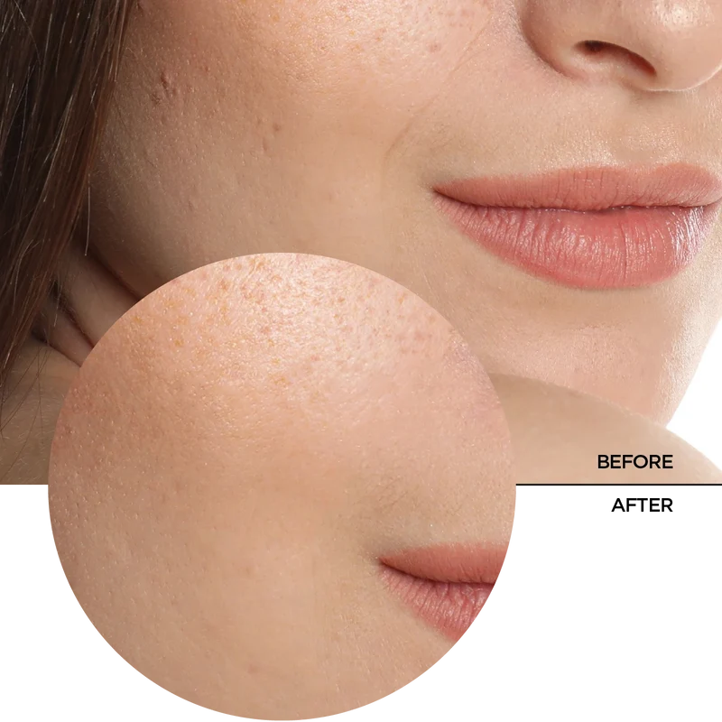 Hyaluronic Acid 5%