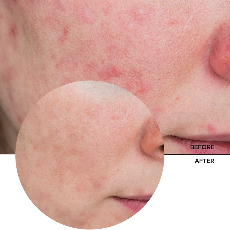 Azelaic Acid 10%