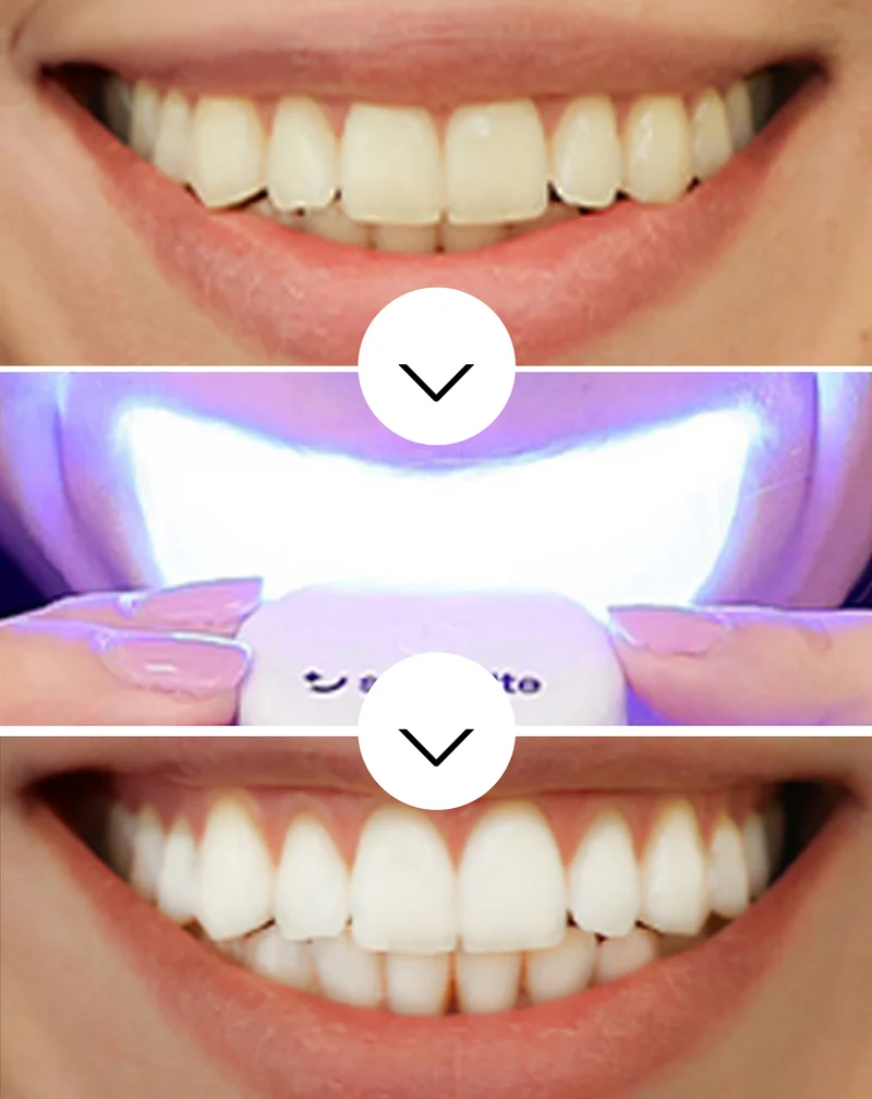 Smilebite Light & Bright LED Kit de blanchiment des dents + 2× Whitesmile Serum™