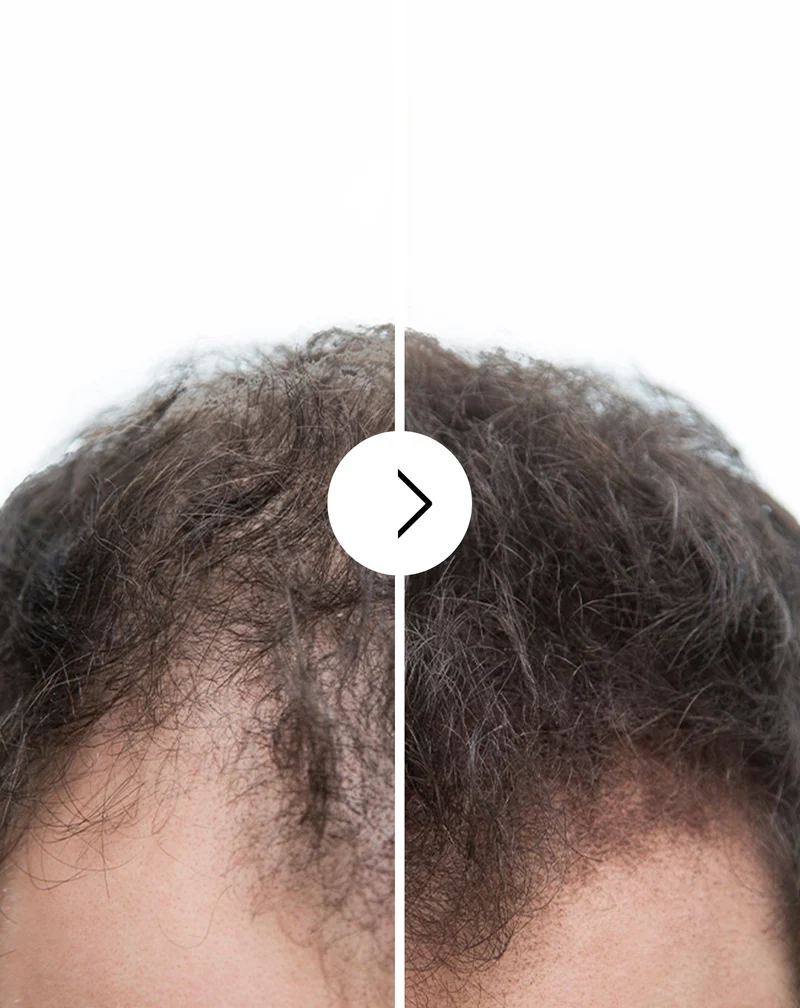 Gélules contre la chute des cheveux à effet épaississant et fortifiant Follixin 60 gélules