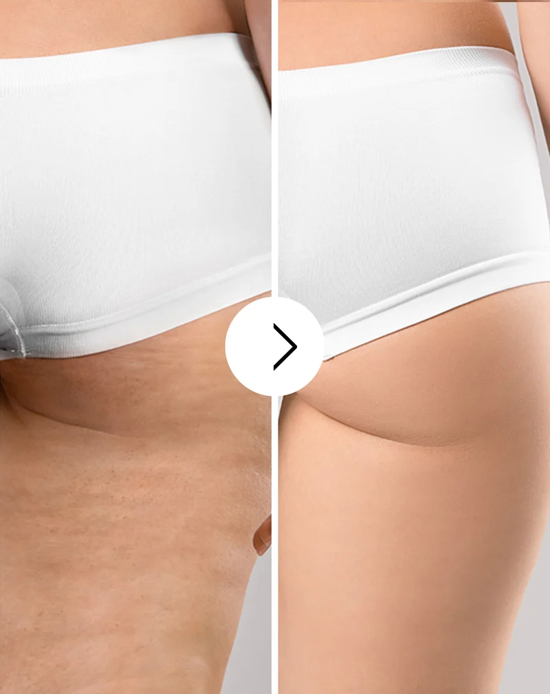 Comprimés de traitement anti-cellulite et pour améliorer les qualités de la peau aux extraits naturels Cellinea 60 gélules
