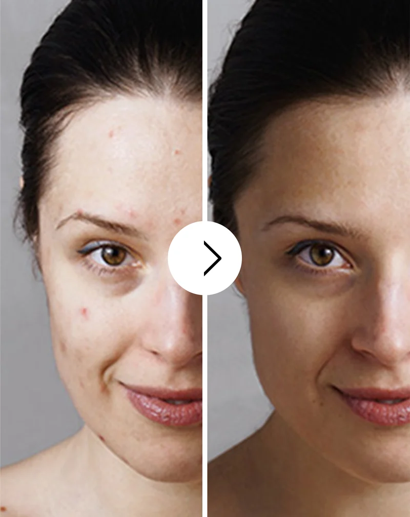 Comprimés pour l’acné, les boutons et les imperfections avec zinc, vitamine C, E et B2 Derminax
