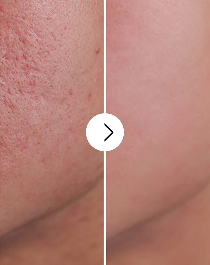 Comprimés pour l’acné, les boutons et les imperfections avec zinc, vitamine C, E et B2 Derminax