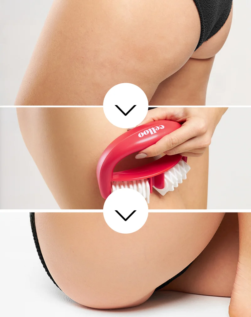Masseur anti-cellulite avec picots pour combattre la cellulite et réduire les tensions musculaires Crush my Celloo