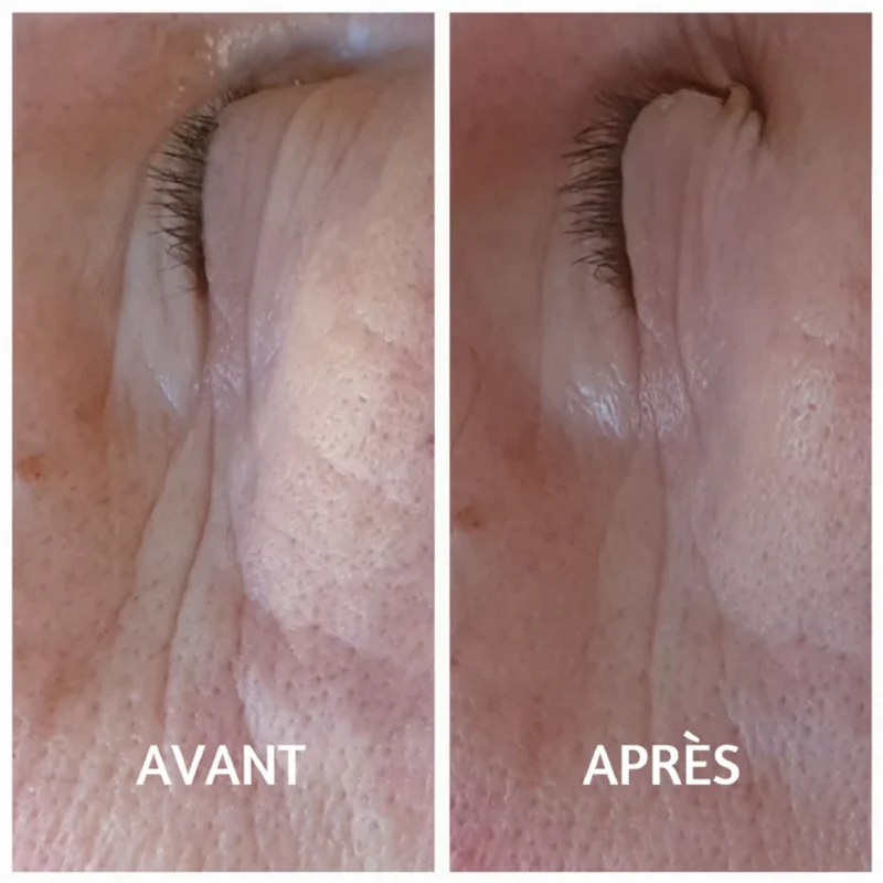 Patch Yeux - Hydrogel