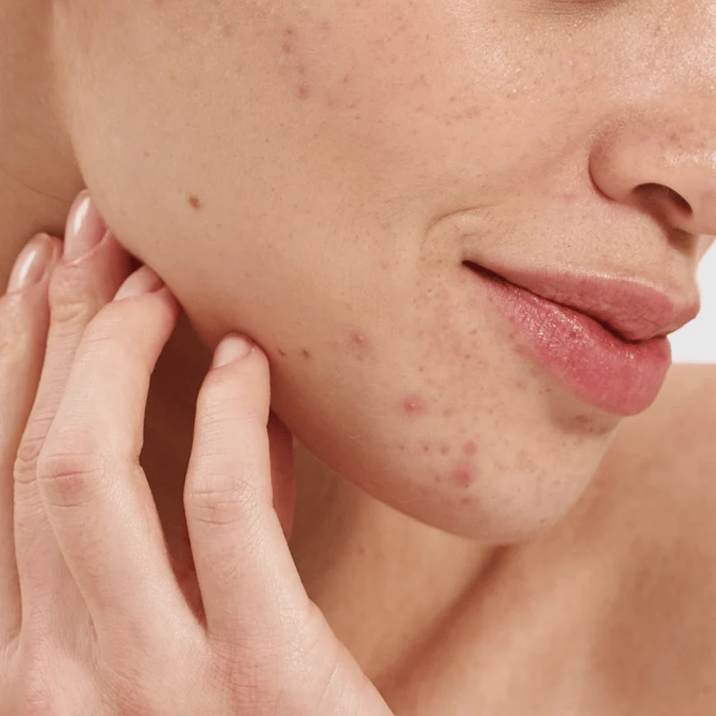 Booster Purifiant à l'Acide Salicylique