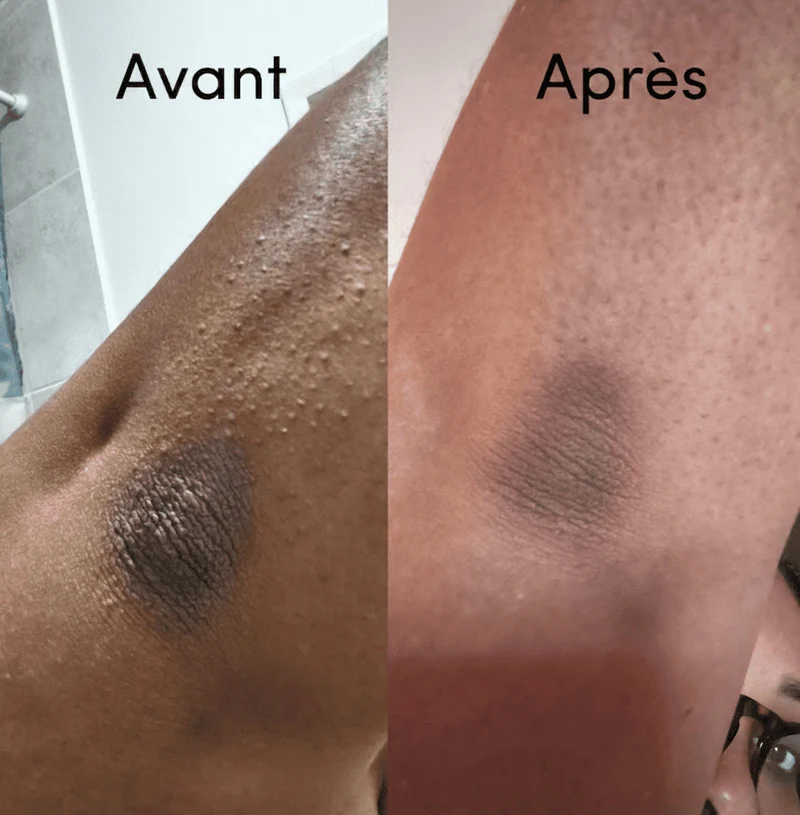 Sérum Exfoliant Corps