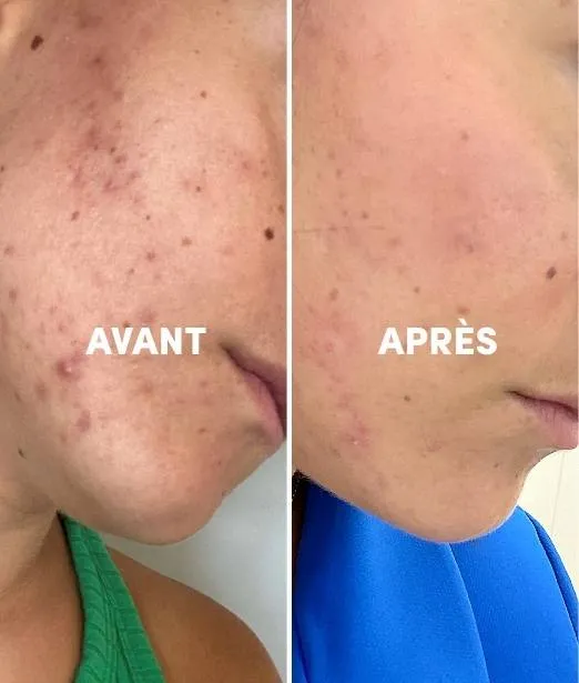 Complément Alimentaire Peau Nette "Acné & Imperfections"